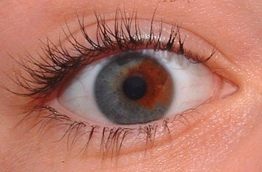iris heterochromia